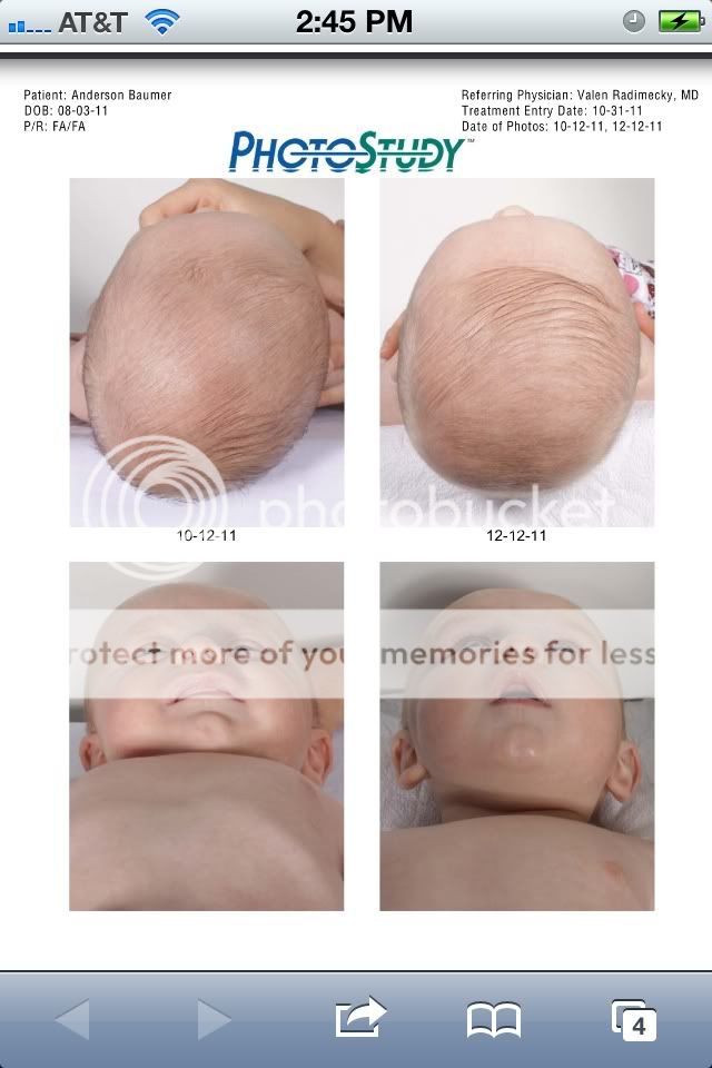 babies head shapes when to worry